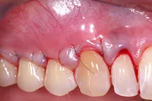 Teeth and gums immediately after an AlloDerm graft