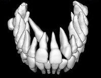 3D model of impacted teeth