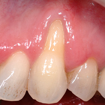 Teeth and gums before an AlloDerm graft