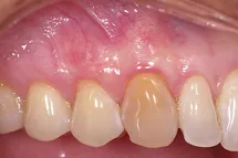 Teeth and gums 3 months after an AlloDerm graft