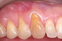 Teeth and gums before an AlloDerm graft