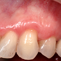 Teeth and gums 3 months after an AlloDerm graft