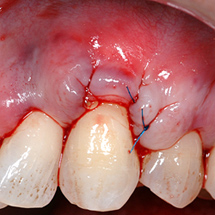 Teeth and gums immediately after an AlloDerm graft