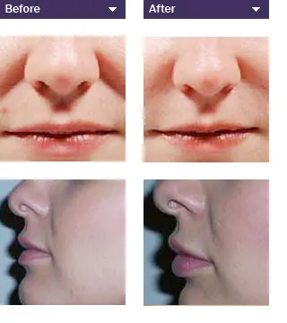 Facial wrinkles before and after treatment with dermal fillers