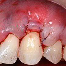 Teeth and gums immediately after an AlloDerm graft