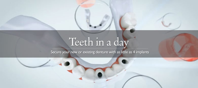 Teeth in a day graphic