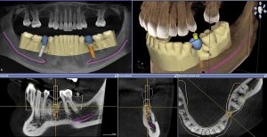 X-ray images of guided surgery procedures