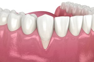 Before animation of Gingival Grafting