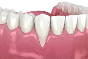 Before animation of Gingival Grafting