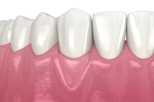 After animation of Gingival Grafting