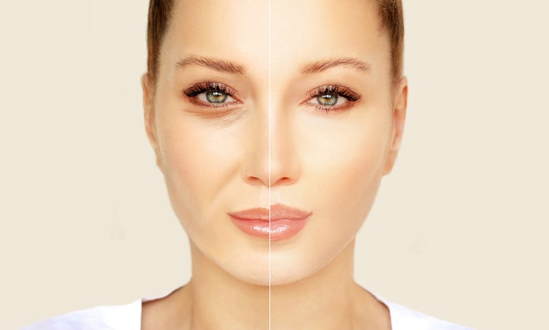 Before and after photo of facial fillers